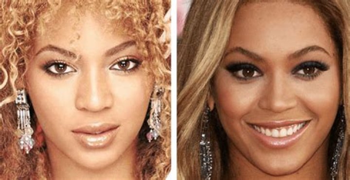 Beyonce Chirurgie