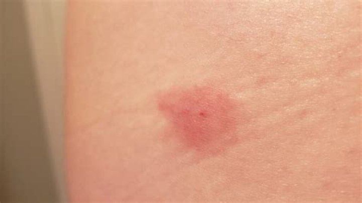 	BITES FROM BIG APPLE, VIA POPPIES	