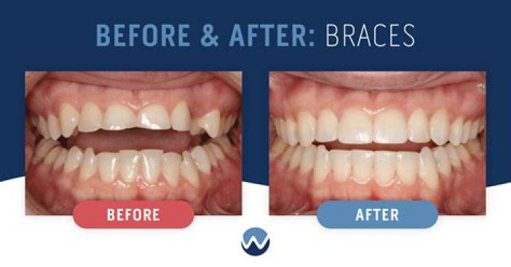 Braces & Dental Work (Operation); Before and After Pictures Examined!