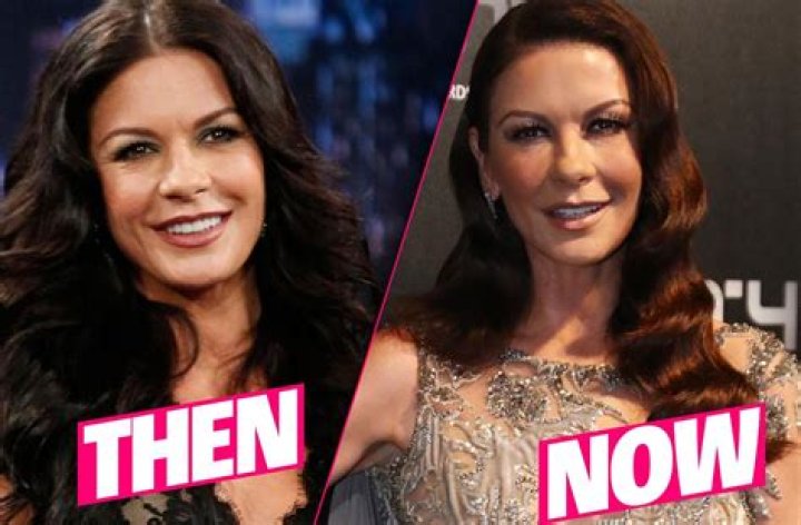 Catherine Zeta-Jones: A Look Into Her Surgery Journey
