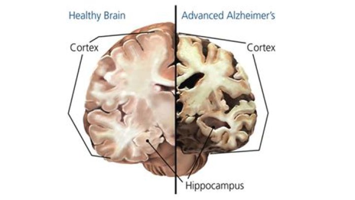 Dementia and the brain | Alzheimer's Society