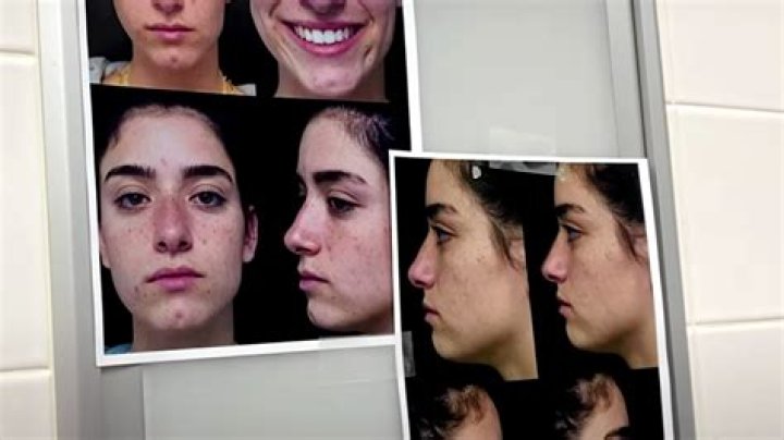 Dixie D'Amelio tears up over painful nose surgery aftermath in BTS vlog