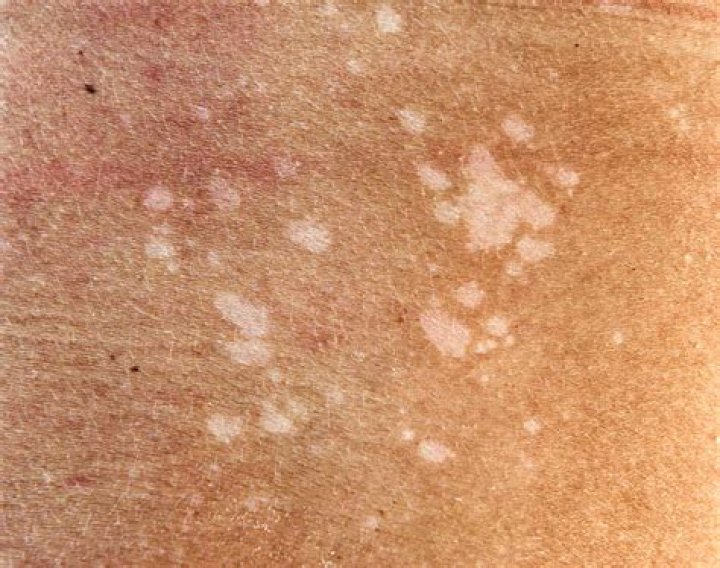 	Fungus causes white spots	