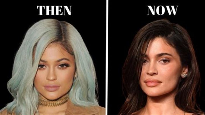 Kylie Before Surgery: A Comprehensive Look At Her Transformation