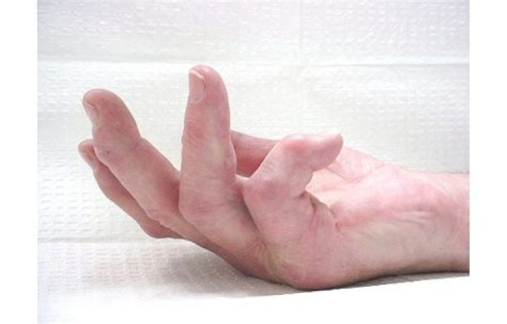 	Local MD Will Speak on Crippling Hand Disease Which Affects Many Seniors	