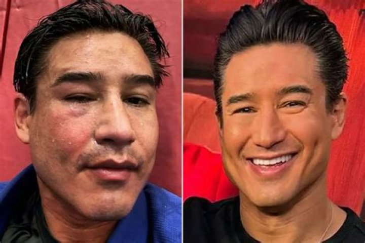 Mario Lopez Plastic Surgery: A Comprehensive Look At His Transformation