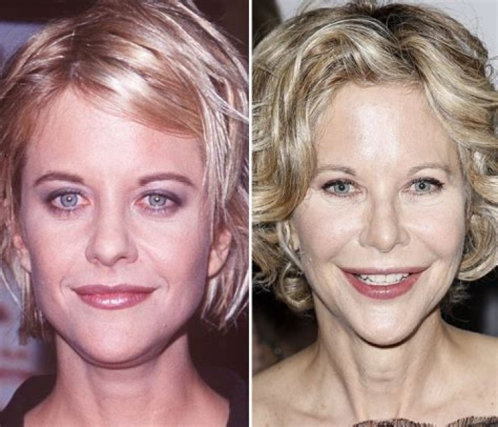 Meg Ryan Chirurgie Esthetique