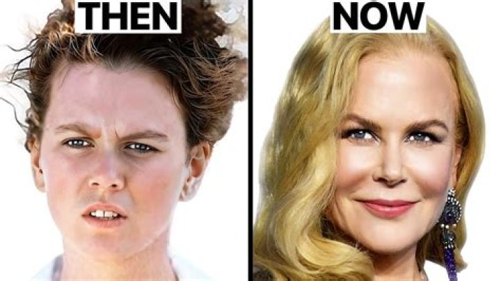 Navigating The World Of Nicole Kidman And Botox: A Comprehensive Exploration