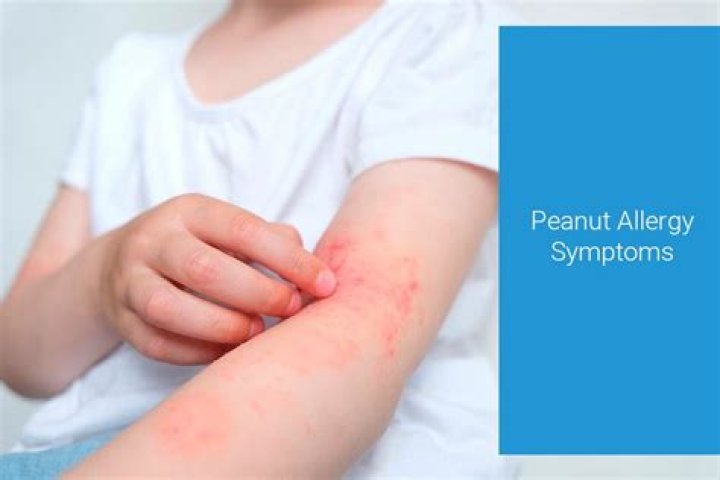 	Peanut allergy may begin in the genes, study shows	