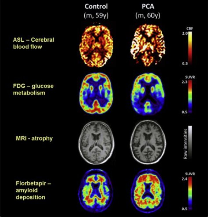 Posterior cortical atrophy | Alzheimer's Society