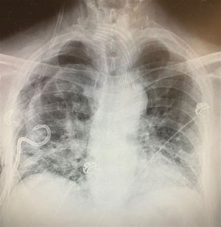 Texas surgeon noticing some post-COVID-19 lungs have more scar tissue than smokers’ lungs
