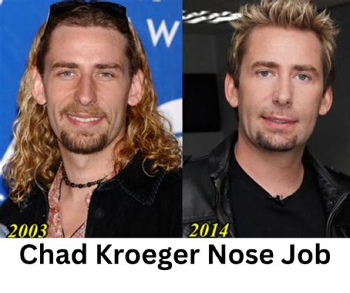Unveiling The Mystery Of Chad Kroeger's Nose