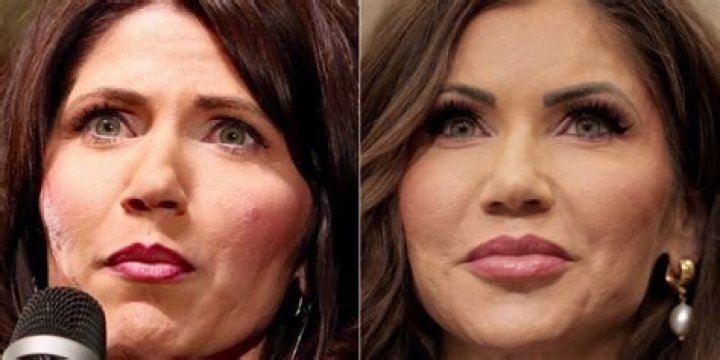 Unveiling The Truth: Kristi Noem And Her Plastic Surgery Journey