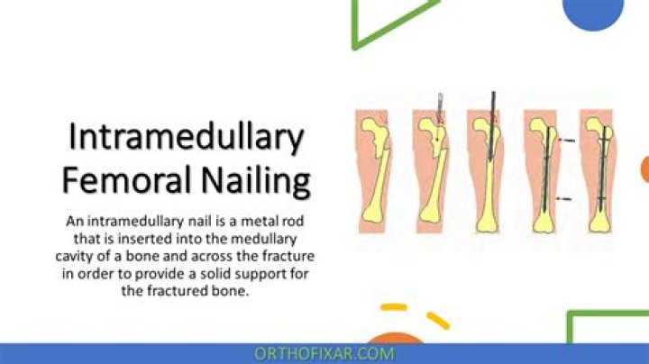 	VELASQUEZ FRACTURES	