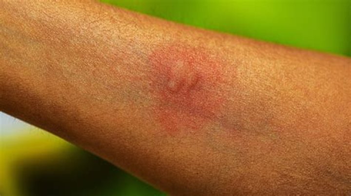 We finally know why some people get more mosquito bites than others