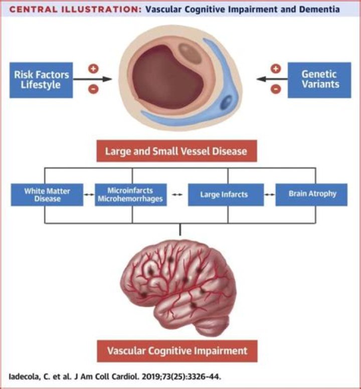 What is vascular dementia? | Alzheimer's Society